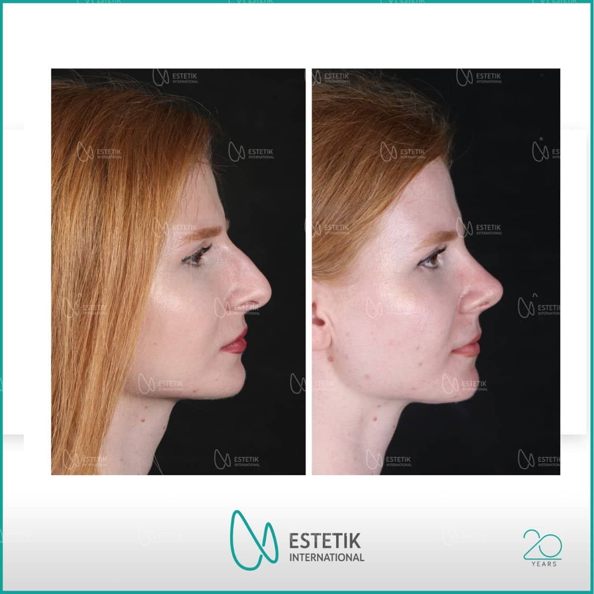 Case 14479 - rhinoplasty