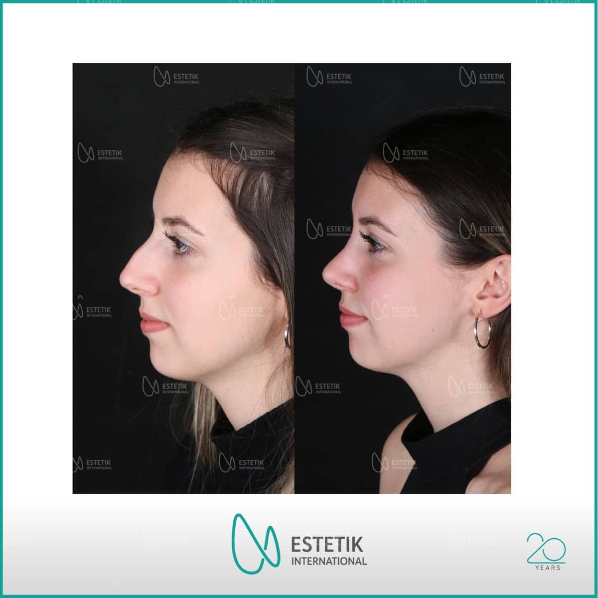 Case 14481 - septoplasty