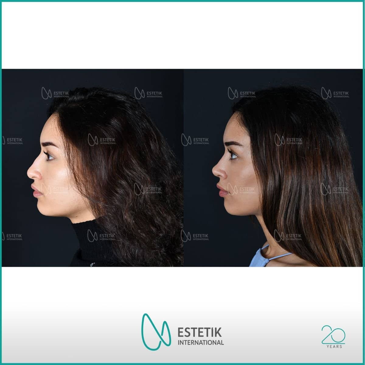 Case 14482 - rhinoplasty
