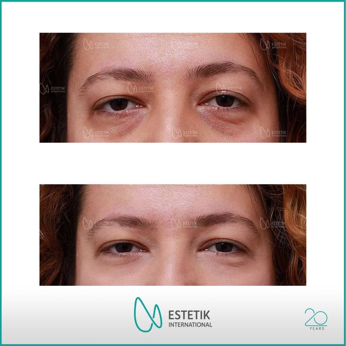 Case 14483 - blepharoplasty