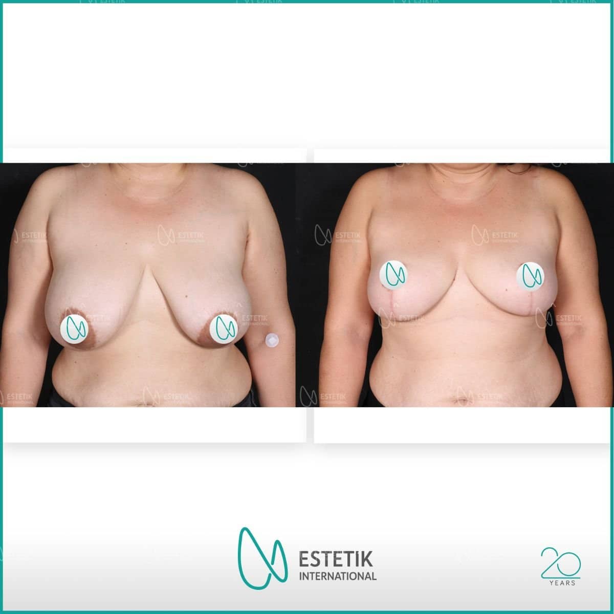 Case 14485 - breast lift