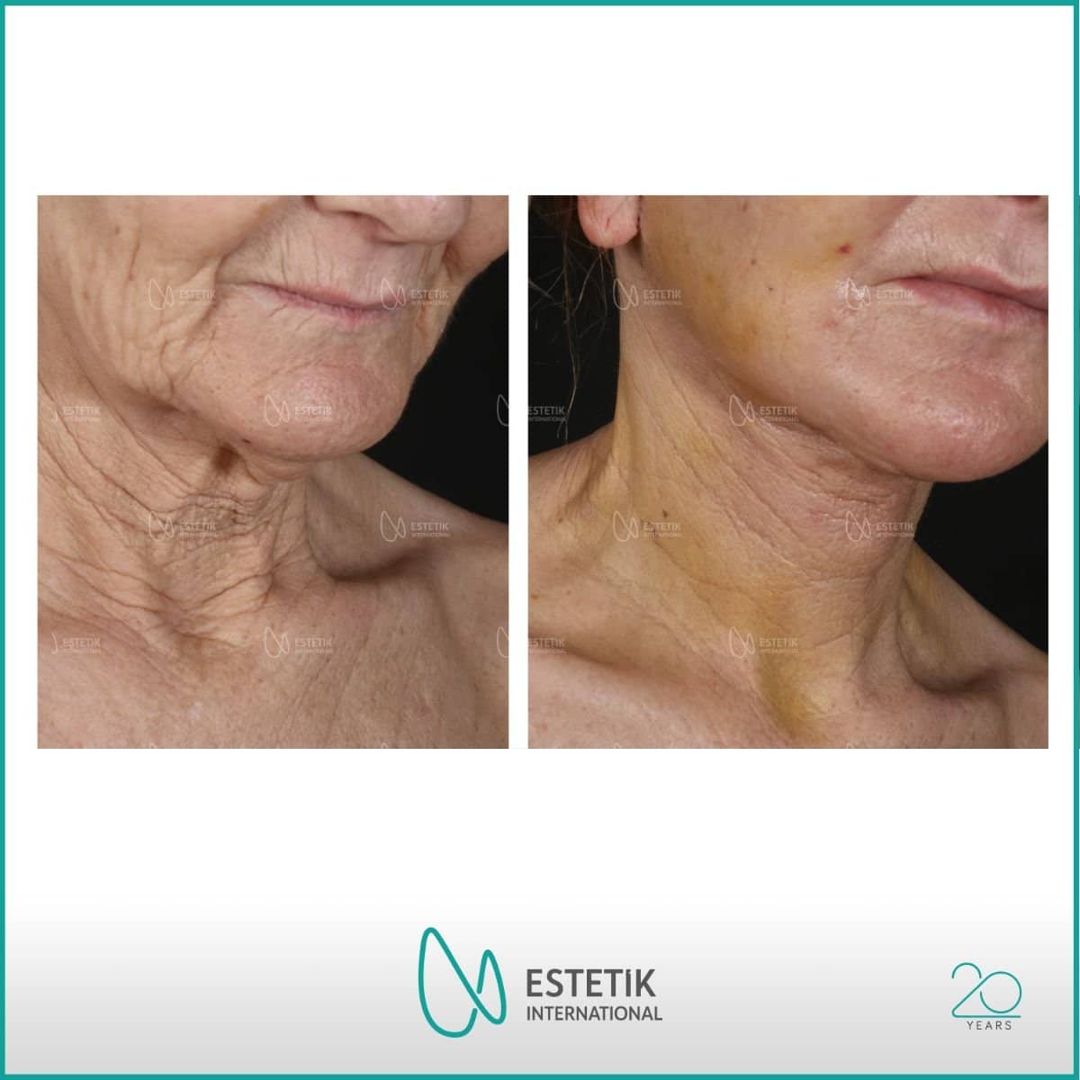 Case 14488 - deep plane facelift