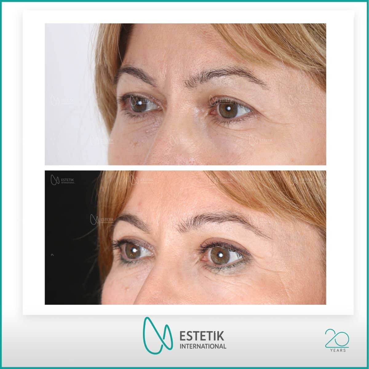 Case 14489 - blepharoplasty