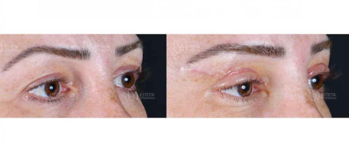 Case 14492 - blepharoplasty