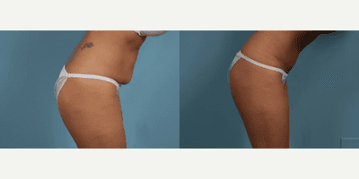 Case 1452 - Woman treated with Tummy Tuck