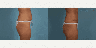 Case 1453 - Woman treated with Tummy Tuck