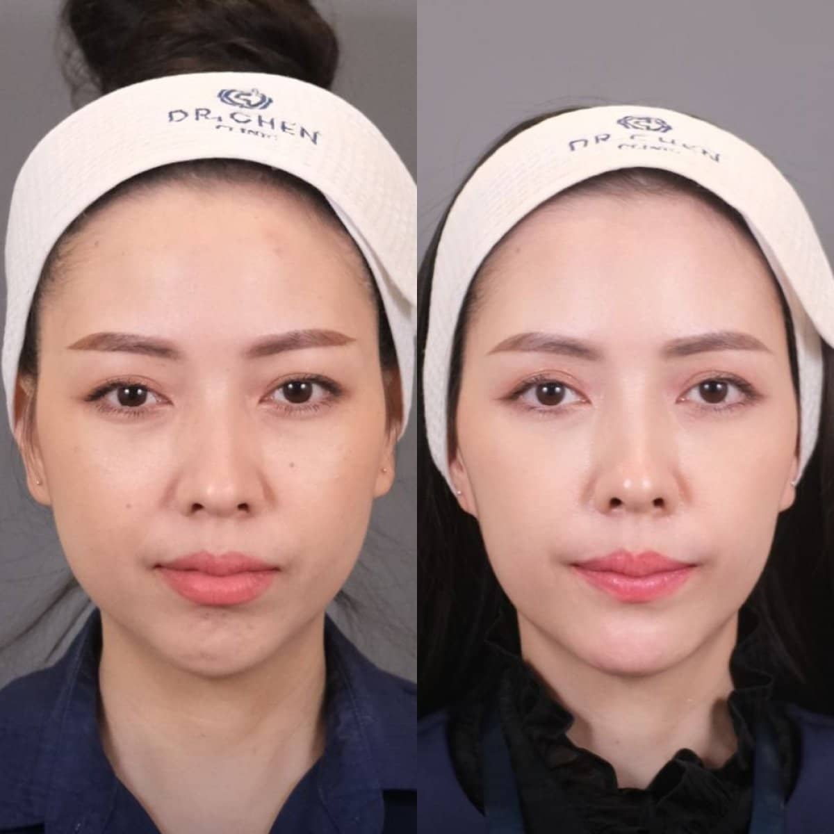 Case 14532 - jawline contouring