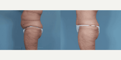 Case 1454 - Woman treated with Tummy Tuck
