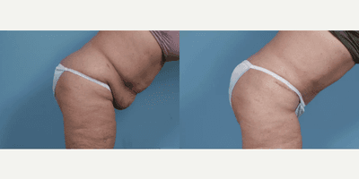Case 1455 - Woman treated with Tummy Tuck