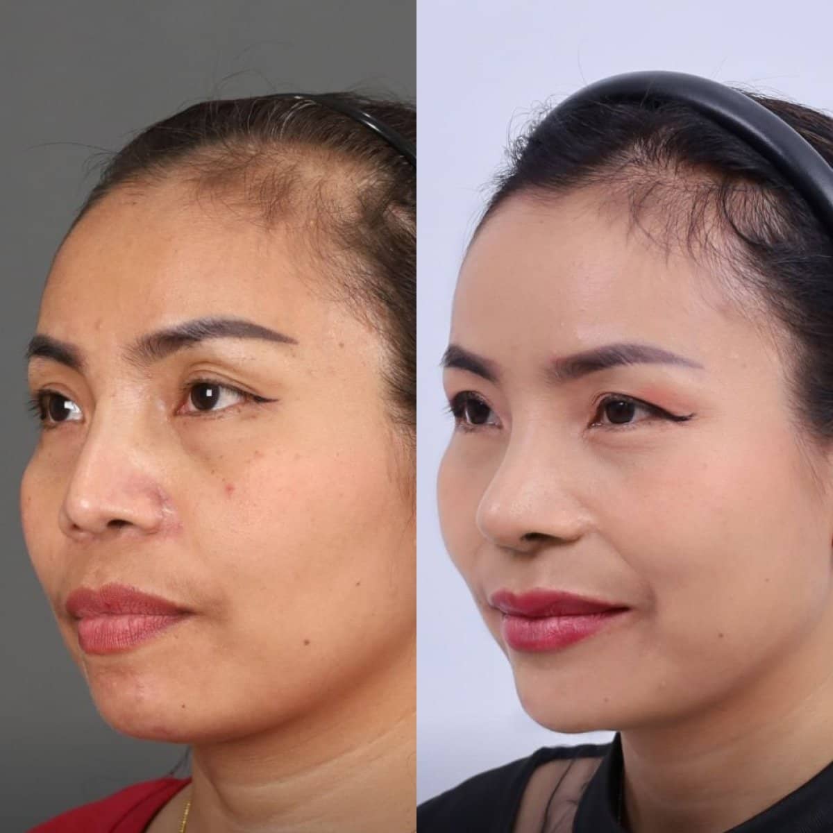 Case 14551 - jawline contouring