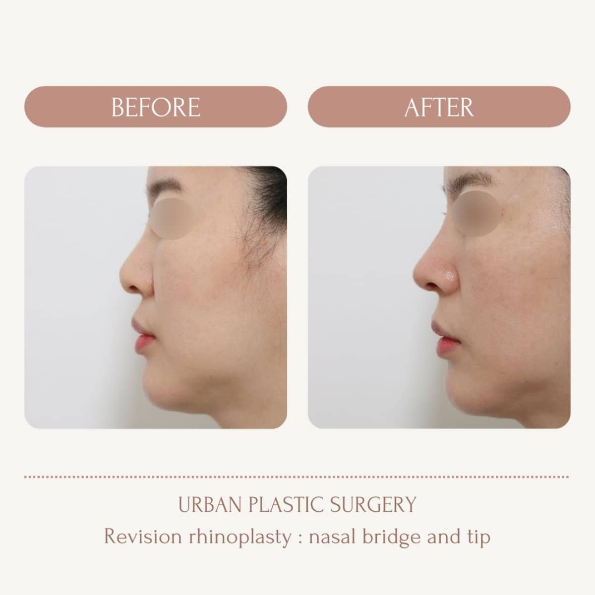 Case 14557 - revision rhinoplasty