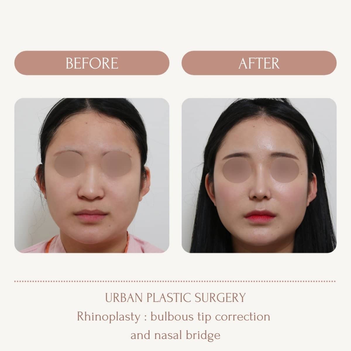 Case 14558 - bulbous nose rhinoplasty