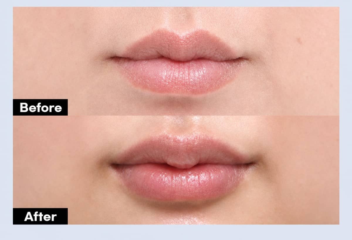 Case 14559 - lip lift