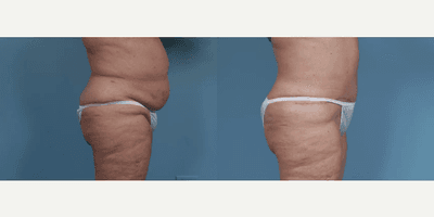 Case 1456 - Woman treated with Tummy Tuck