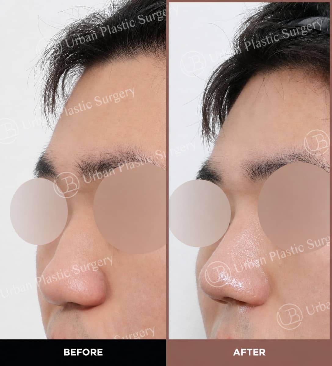 Case 14560 - ultrasonic rhinoplasty