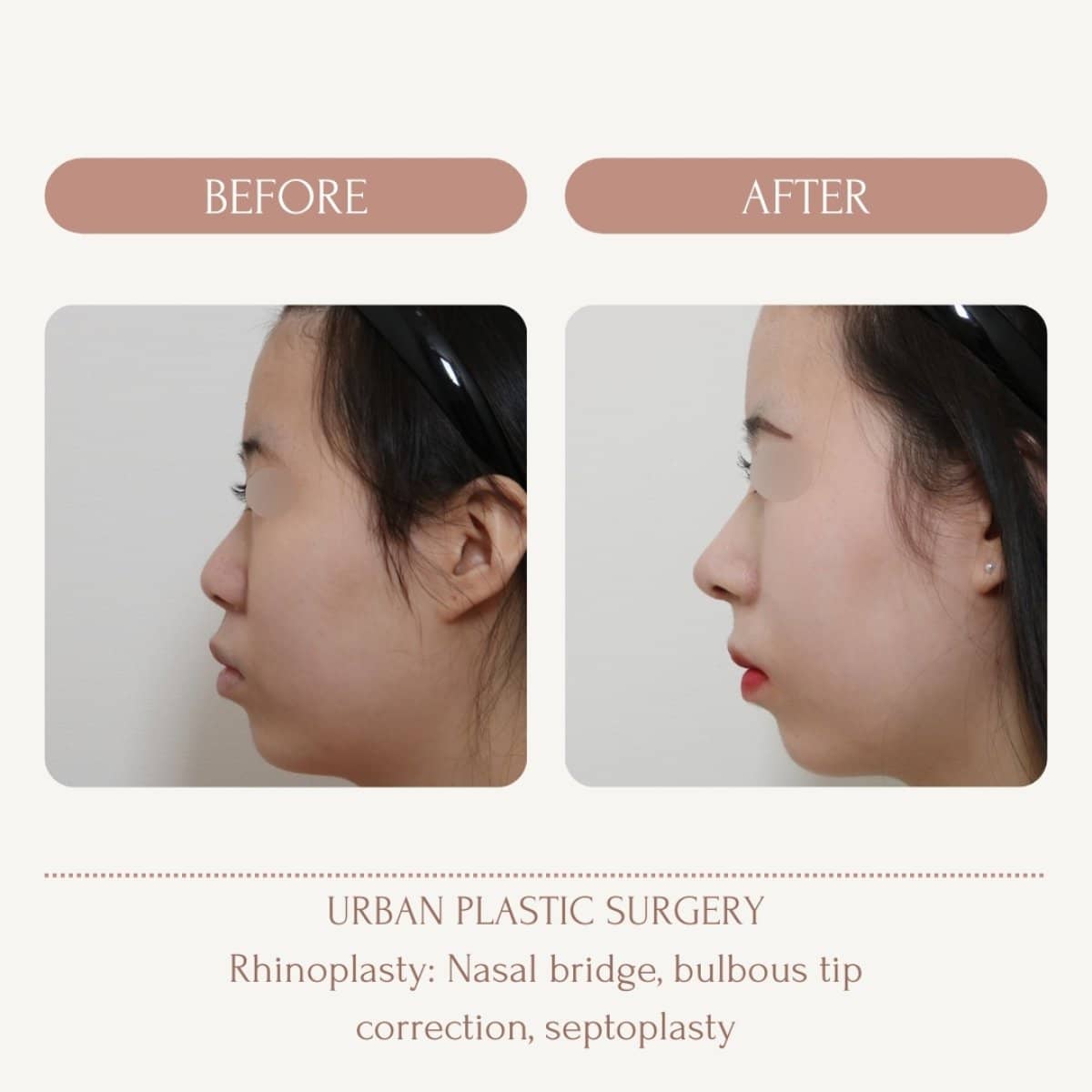 Case 14561 - bulbous nose rhinoplasty