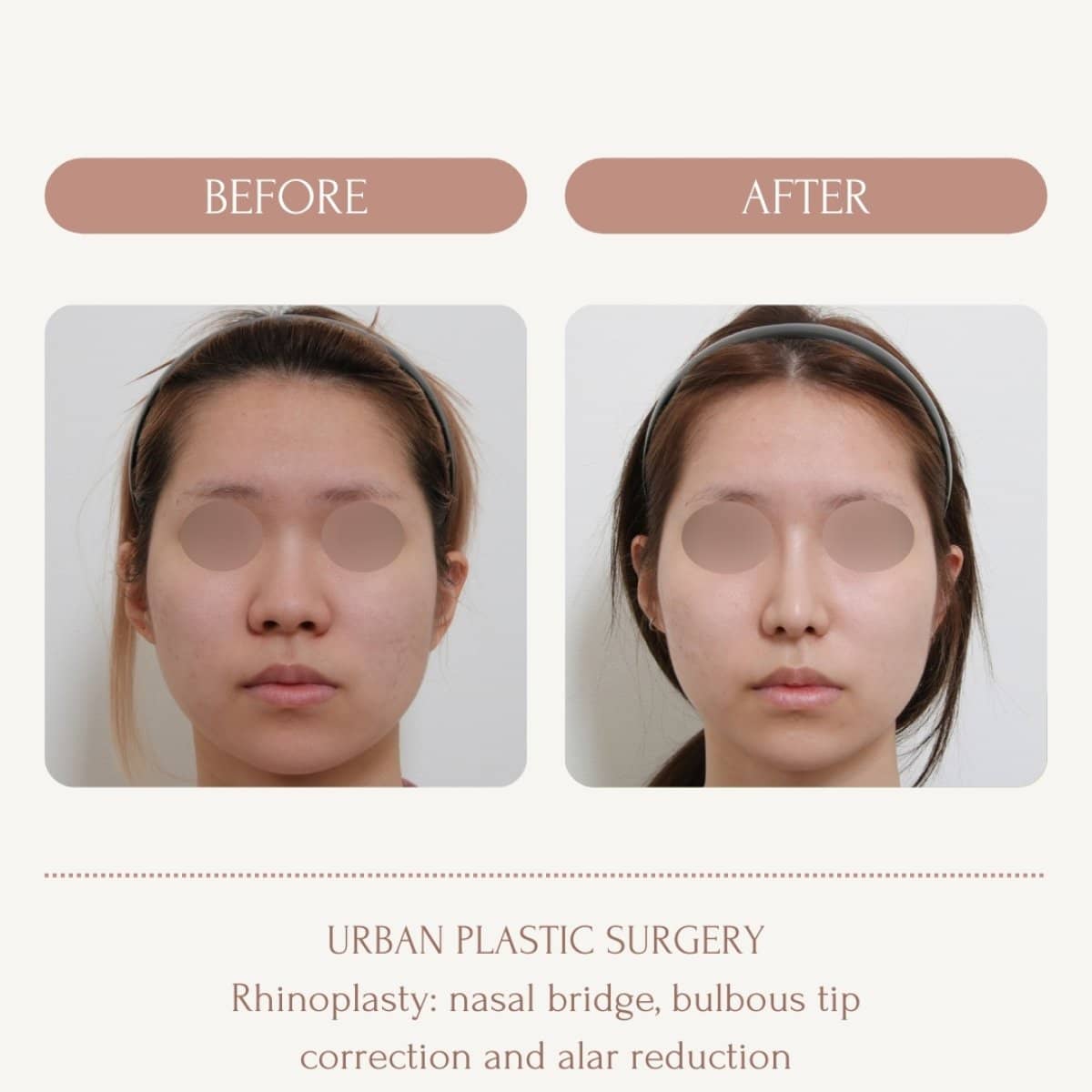 Case 14562 - bulbous nose rhinoplasty