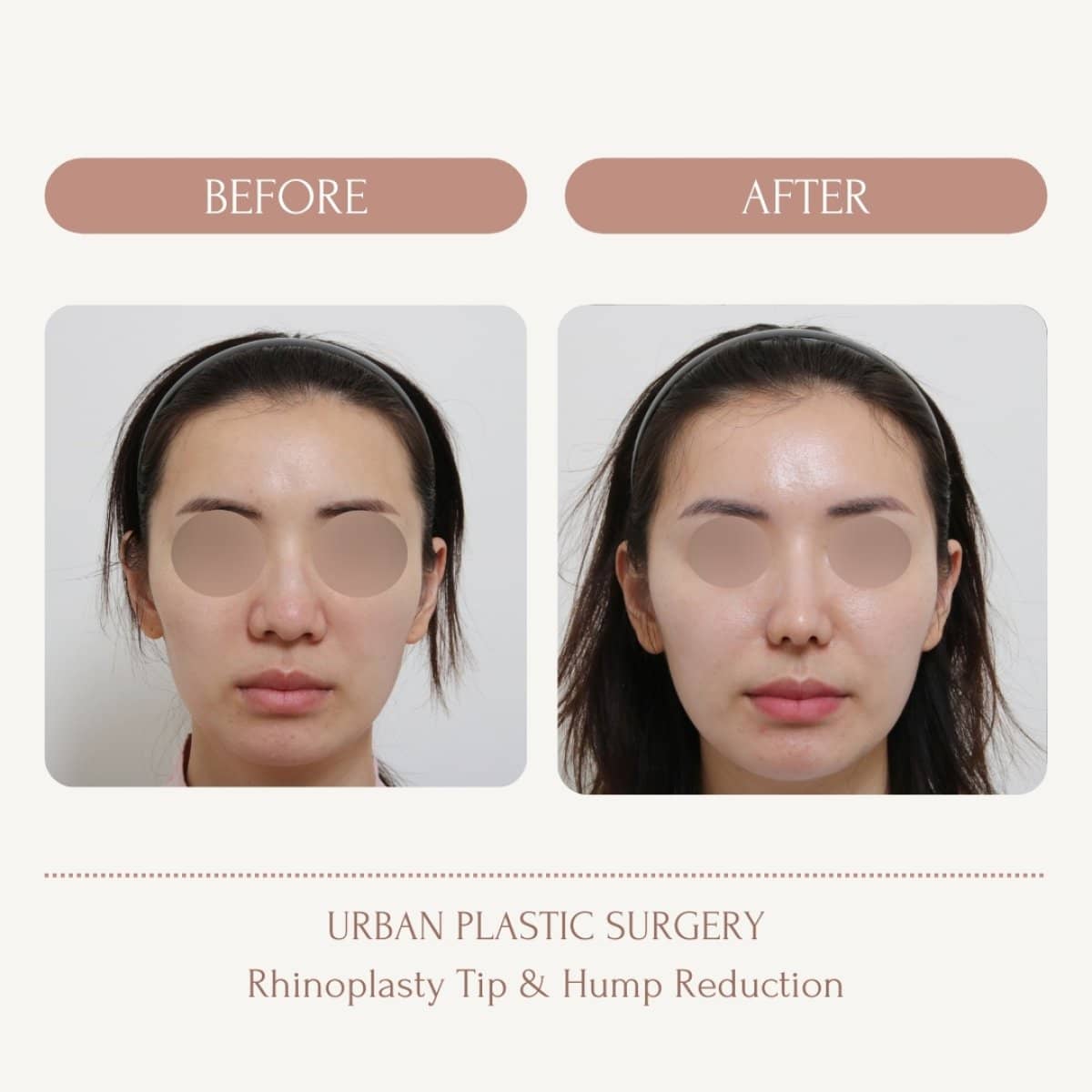 Case 14563 - rhinoplasty tip and hump reduction