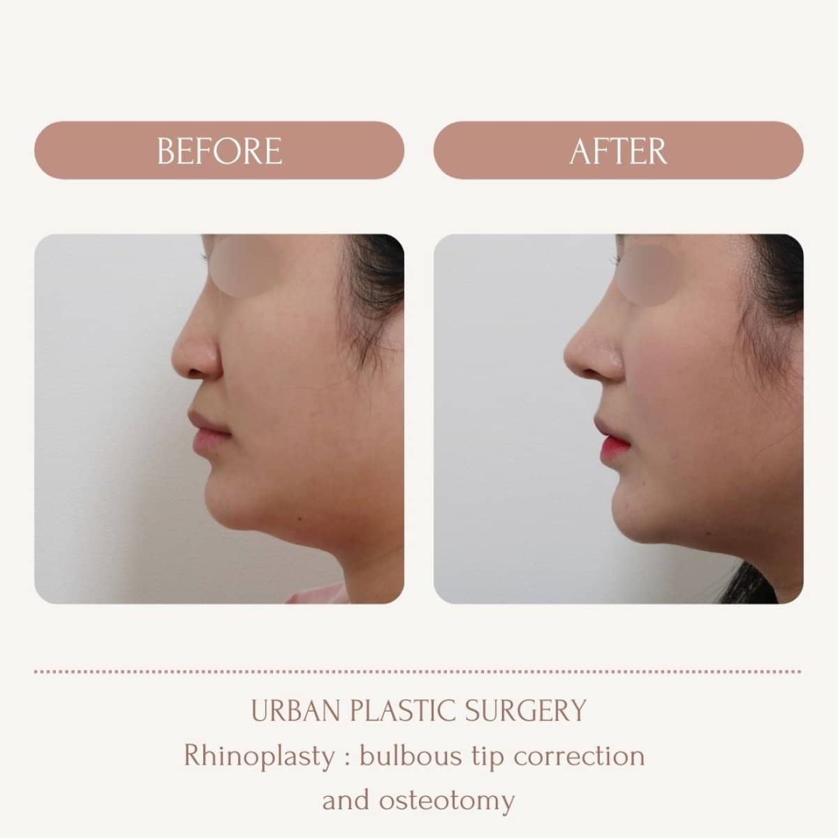 Case 14564 - bulbous nose rhinoplasty