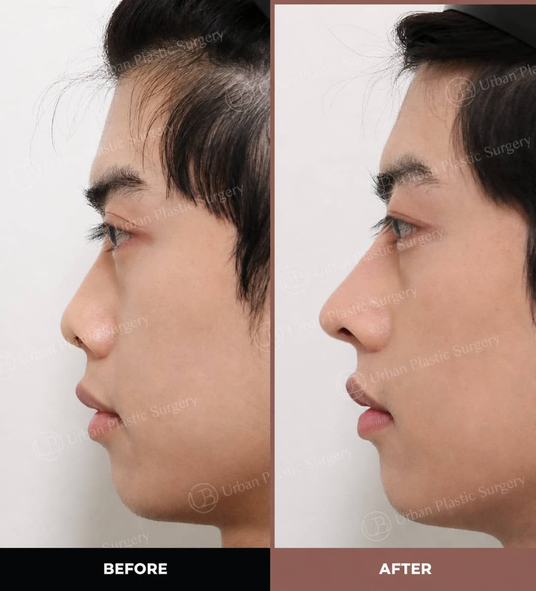 Case 14565 - ultrasonic rhinoplasty