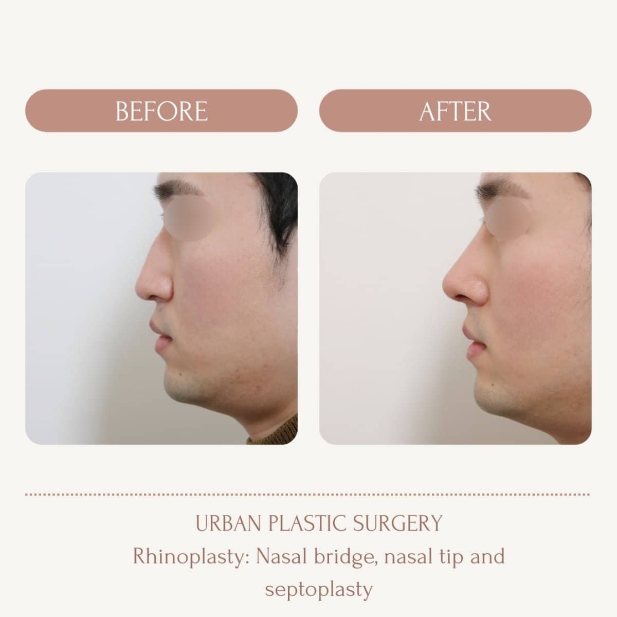 Case 14566 - nasal hump removal