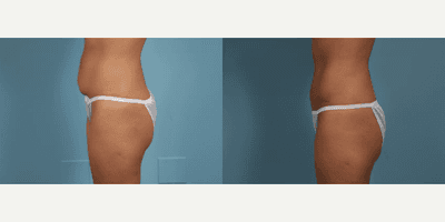 Case 1457 - Woman treated with Tummy Tuck