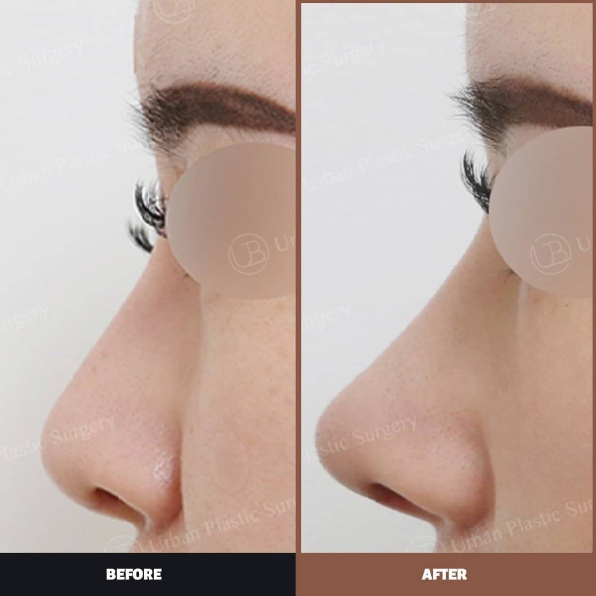 Case 14570 - septoplasty