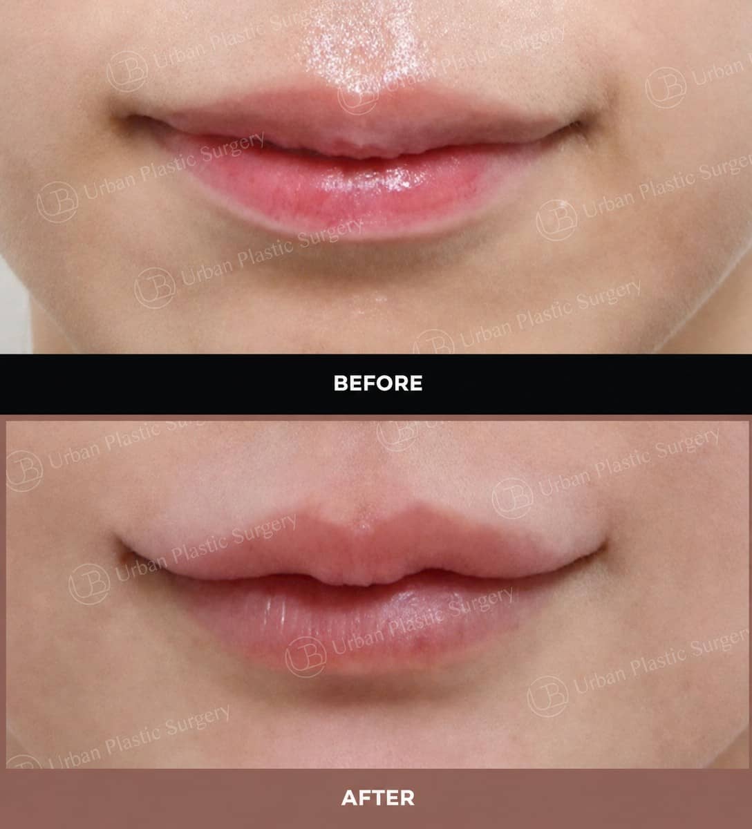 Case 14571 - lip lift