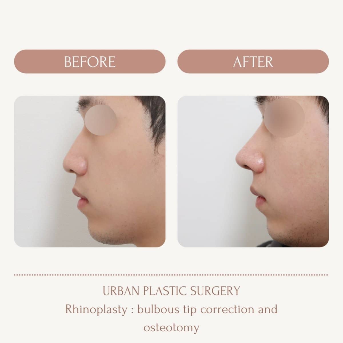 Case 14572 - male rhinoplasty