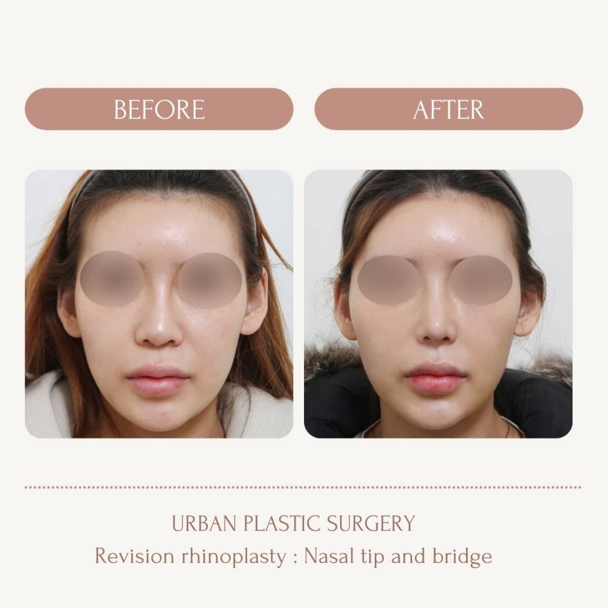 Case 14573 - revision rhinoplasty