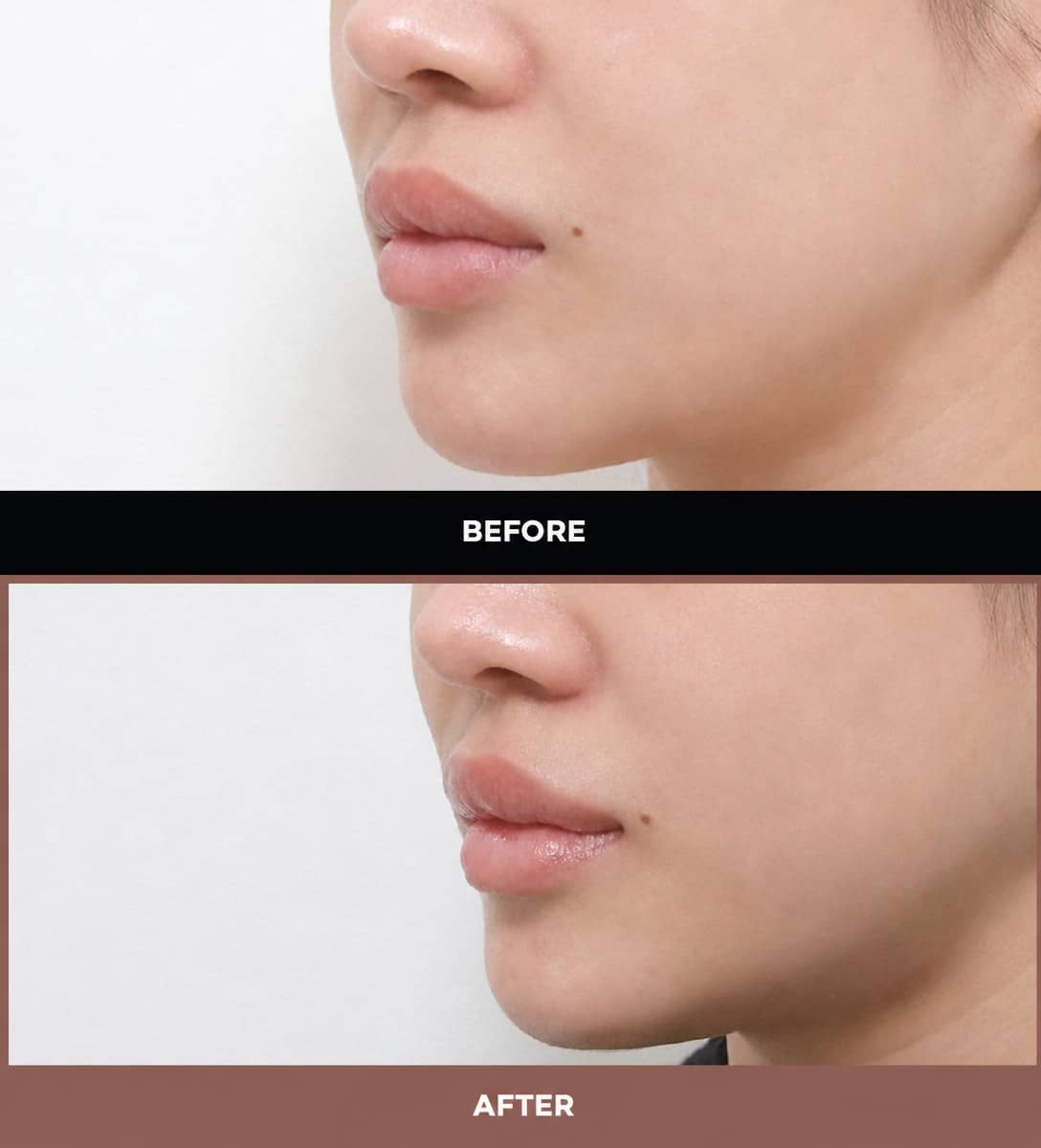 Case 14574 - lip lift