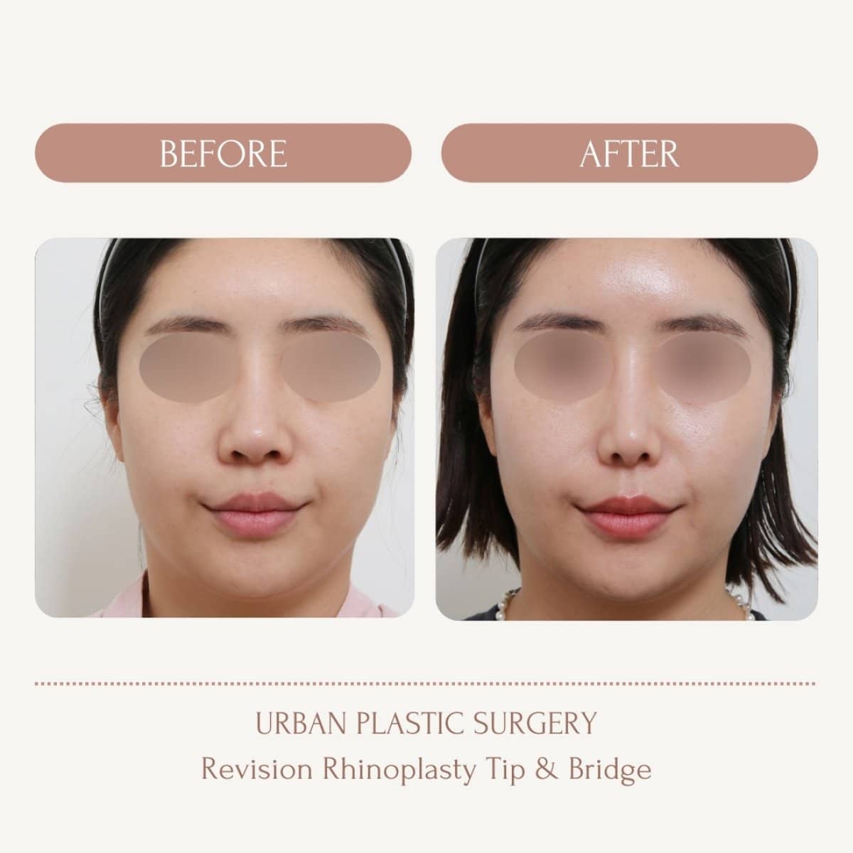 Case 14575 - revision rhinoplasty tip and bridge