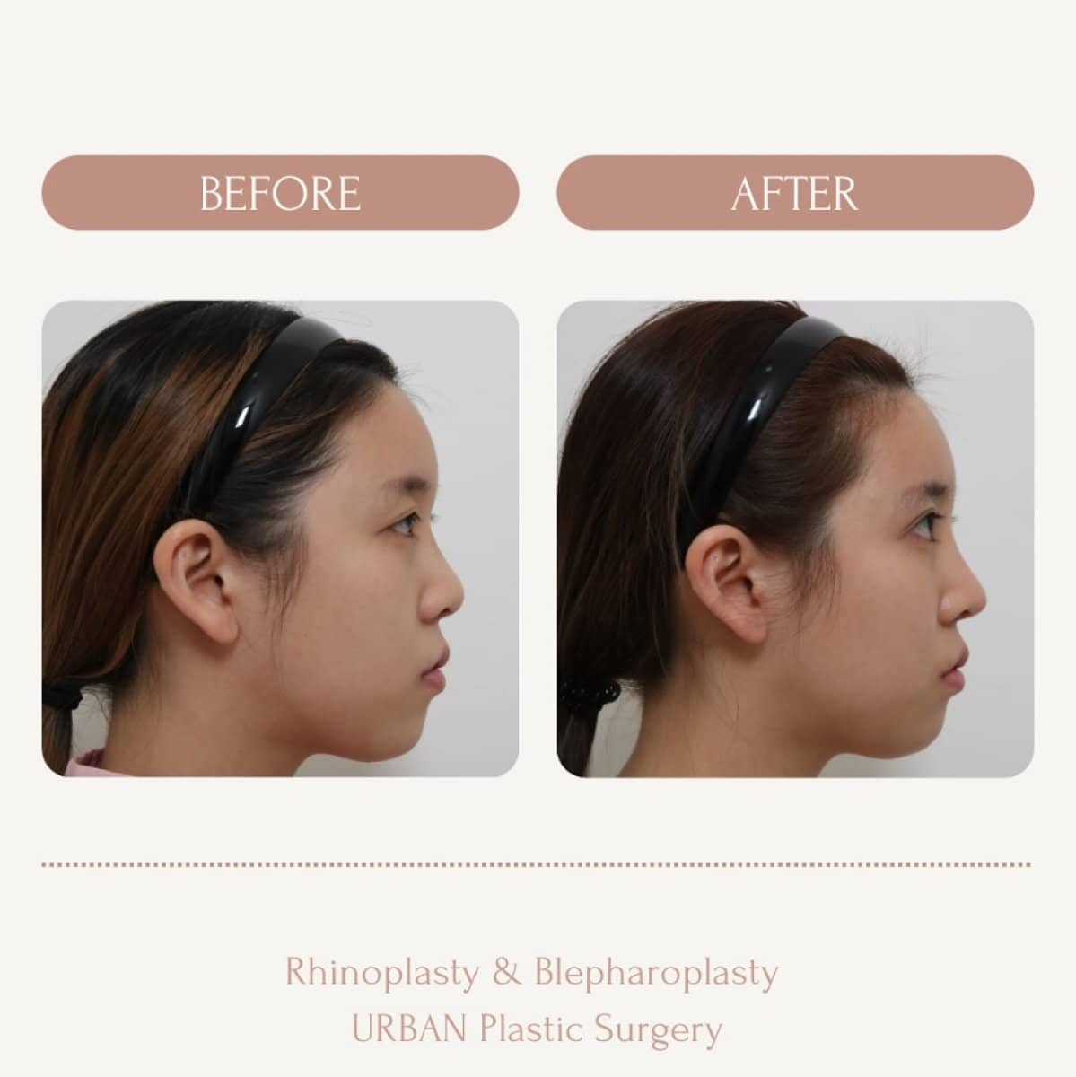 Case 14576 - rhinoplasty and blepharoplasty