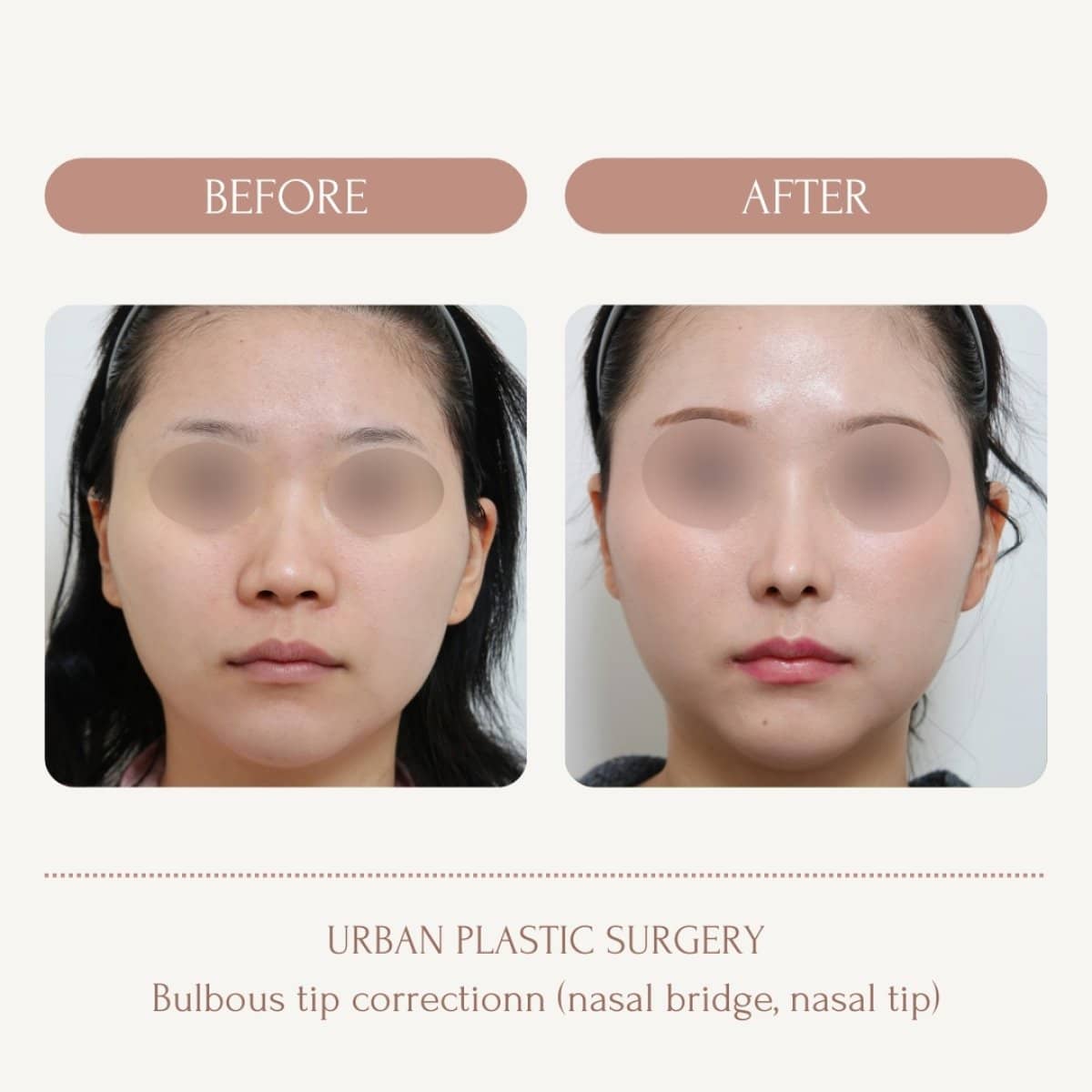 Case 14577 - bulbous nose rhinoplasty