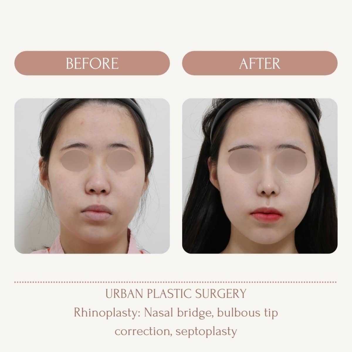 Case 14578 - bulbous nose rhinoplasty