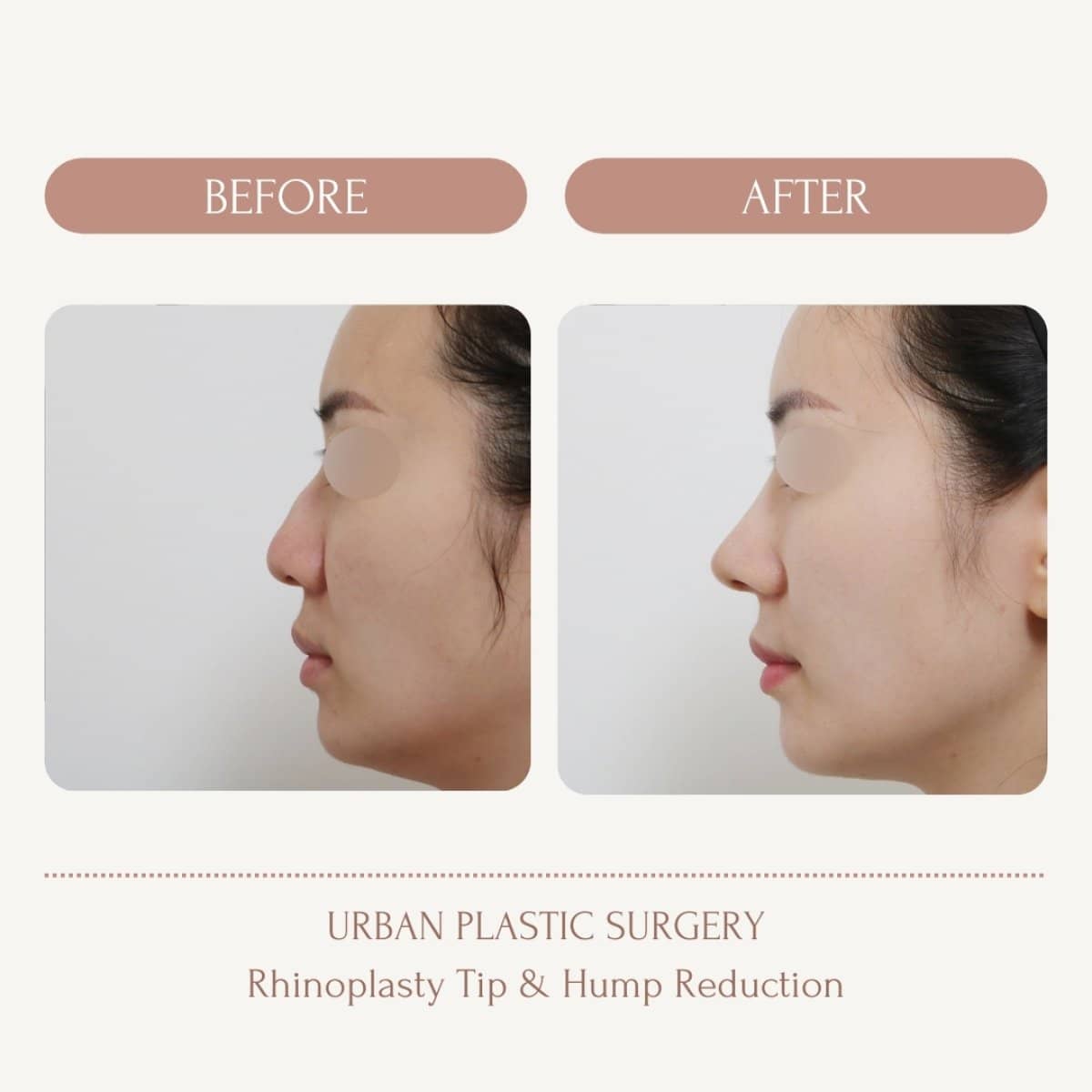 Case 14579 - bulbous nose rhinoplasty