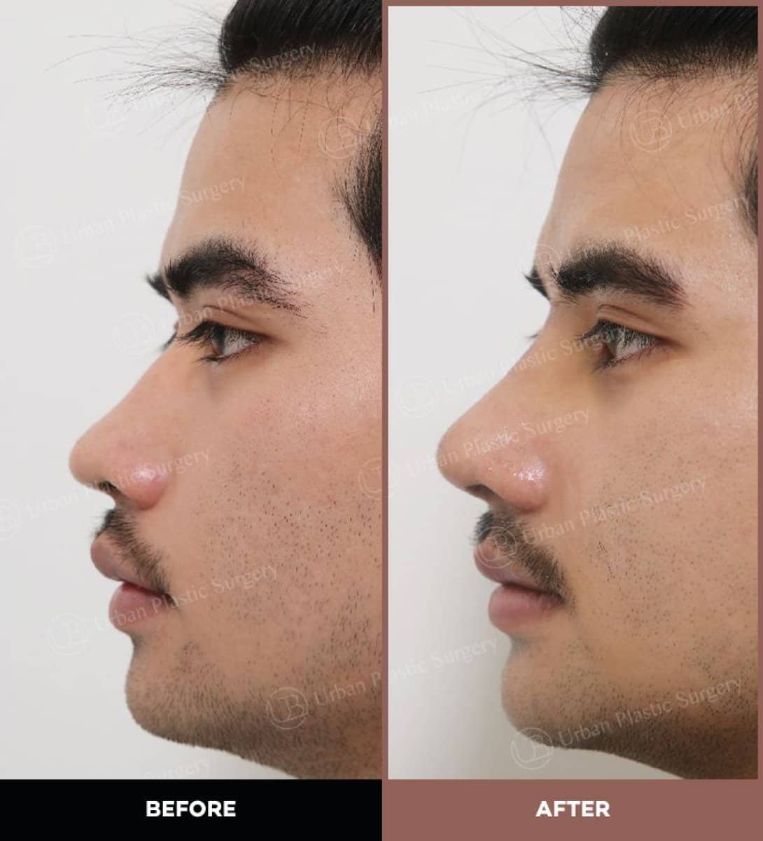 Case 14583 - ultrasonic rhinoplasty