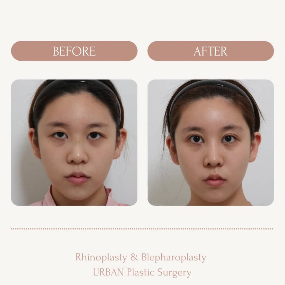 Case 14585 - rhinoplasty and blepharoplasty