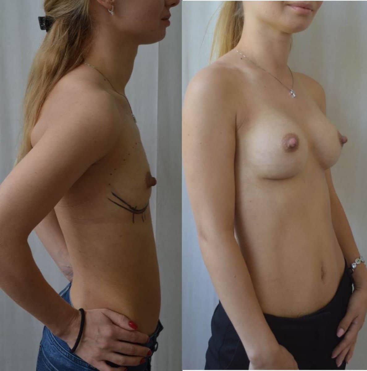 Case 14603 - mammoplasty