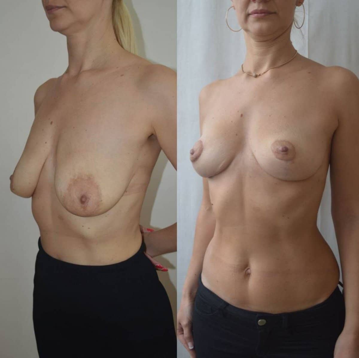 Case 14605 - breast lift