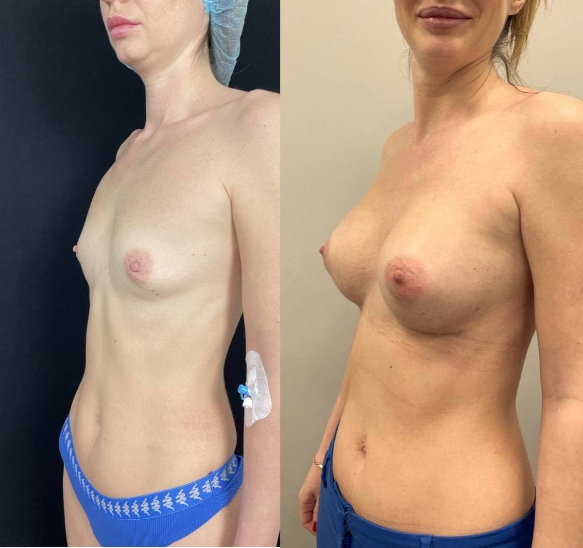 Case 14606 - mammoplasty