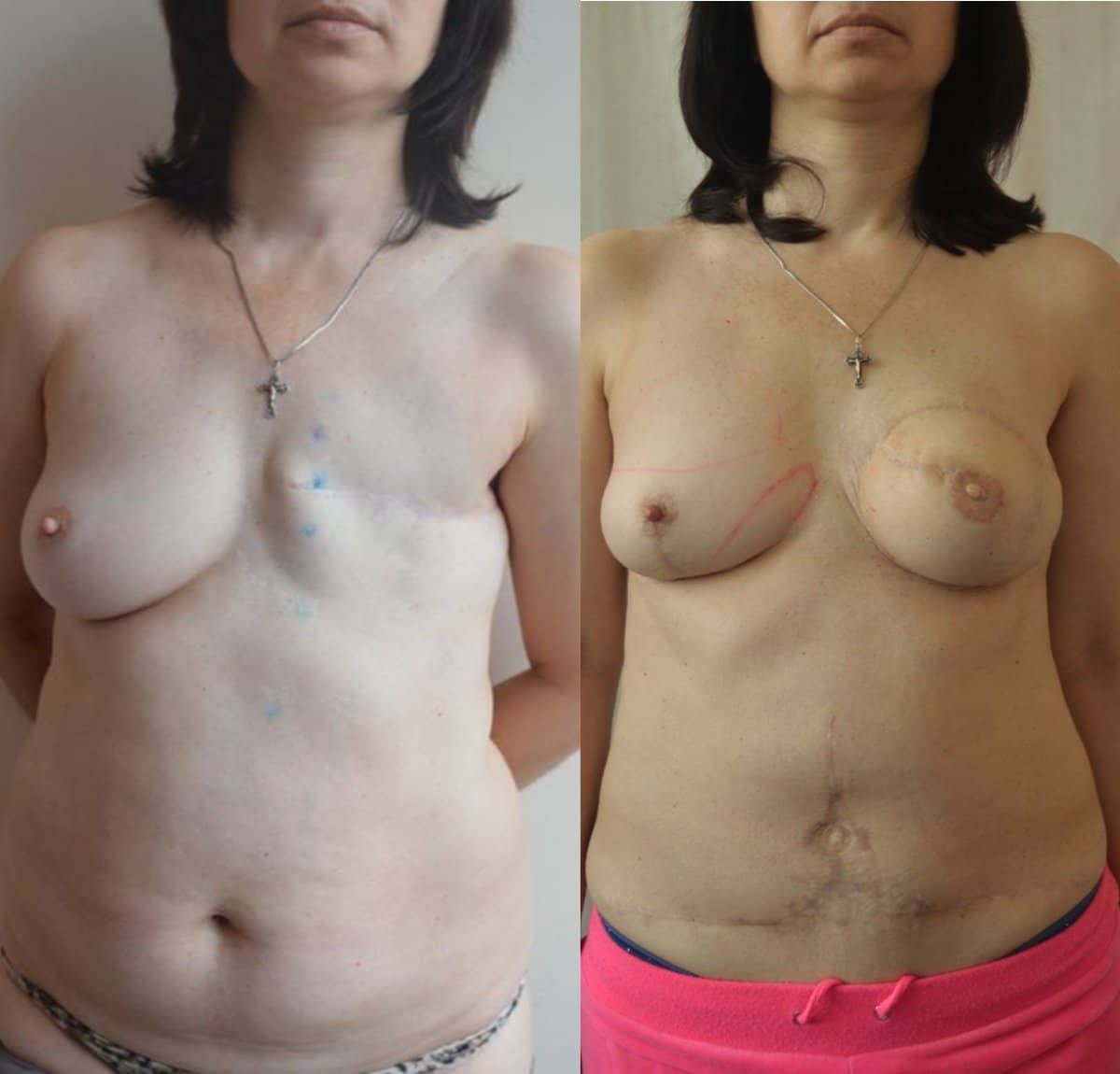 Case 14608 - breast reconstruction surgery