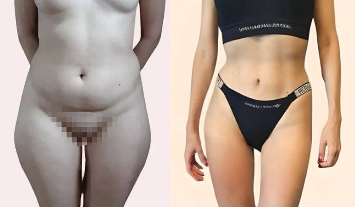 Case 14613 - abdominal liposuction