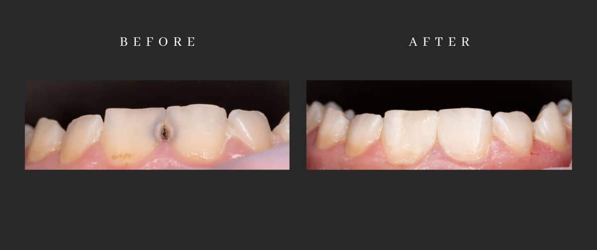 Case 14617 - results of aesthetic composite filling