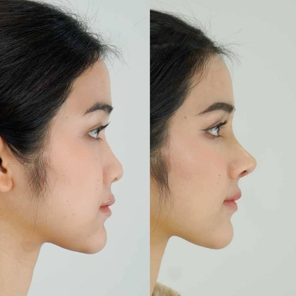 Case 14643 - open rhinoplasty