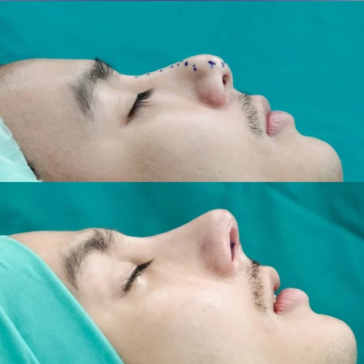Case 14644 - open rhinoplasty