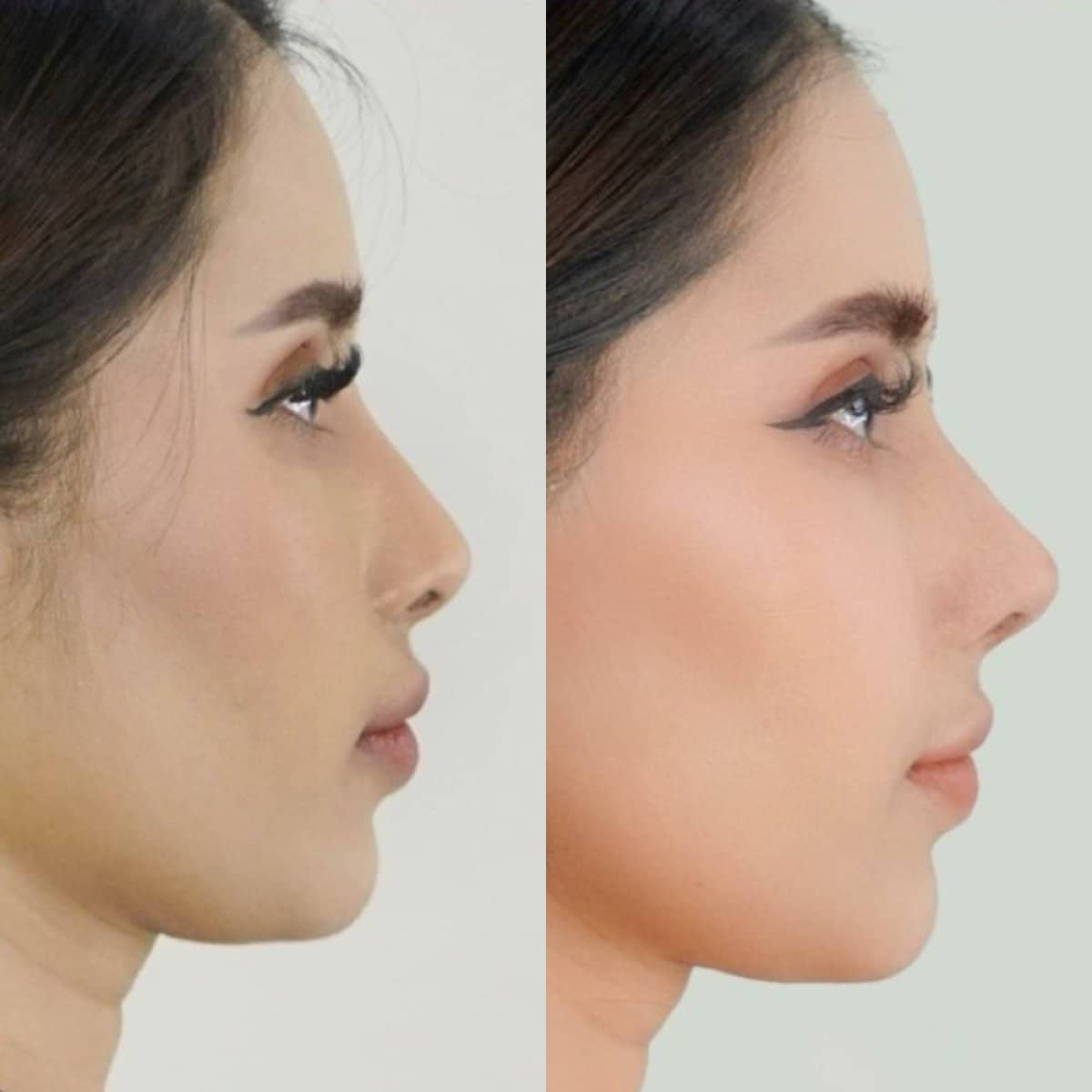 Case 14645 - open rhinoplasty