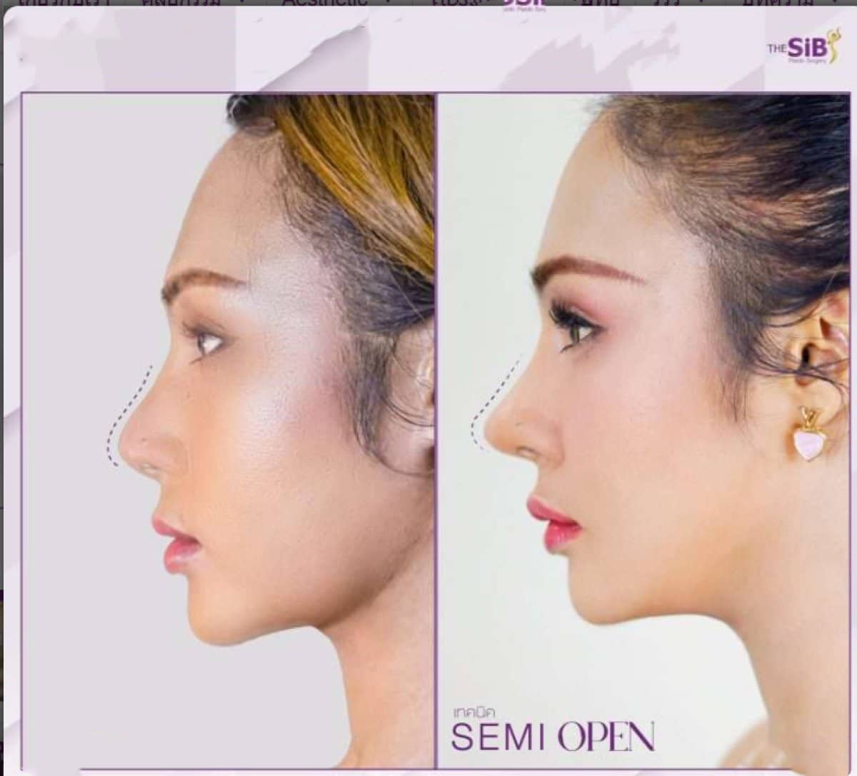 Case 14646 - revision rhinoplasty