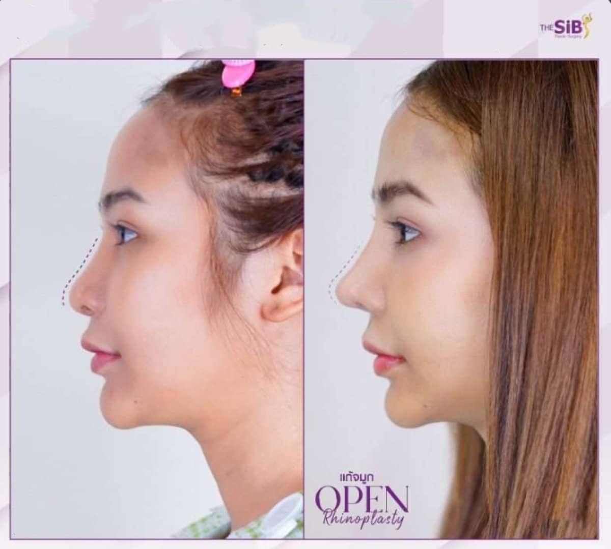 Case 14647 - revision rhinoplasty