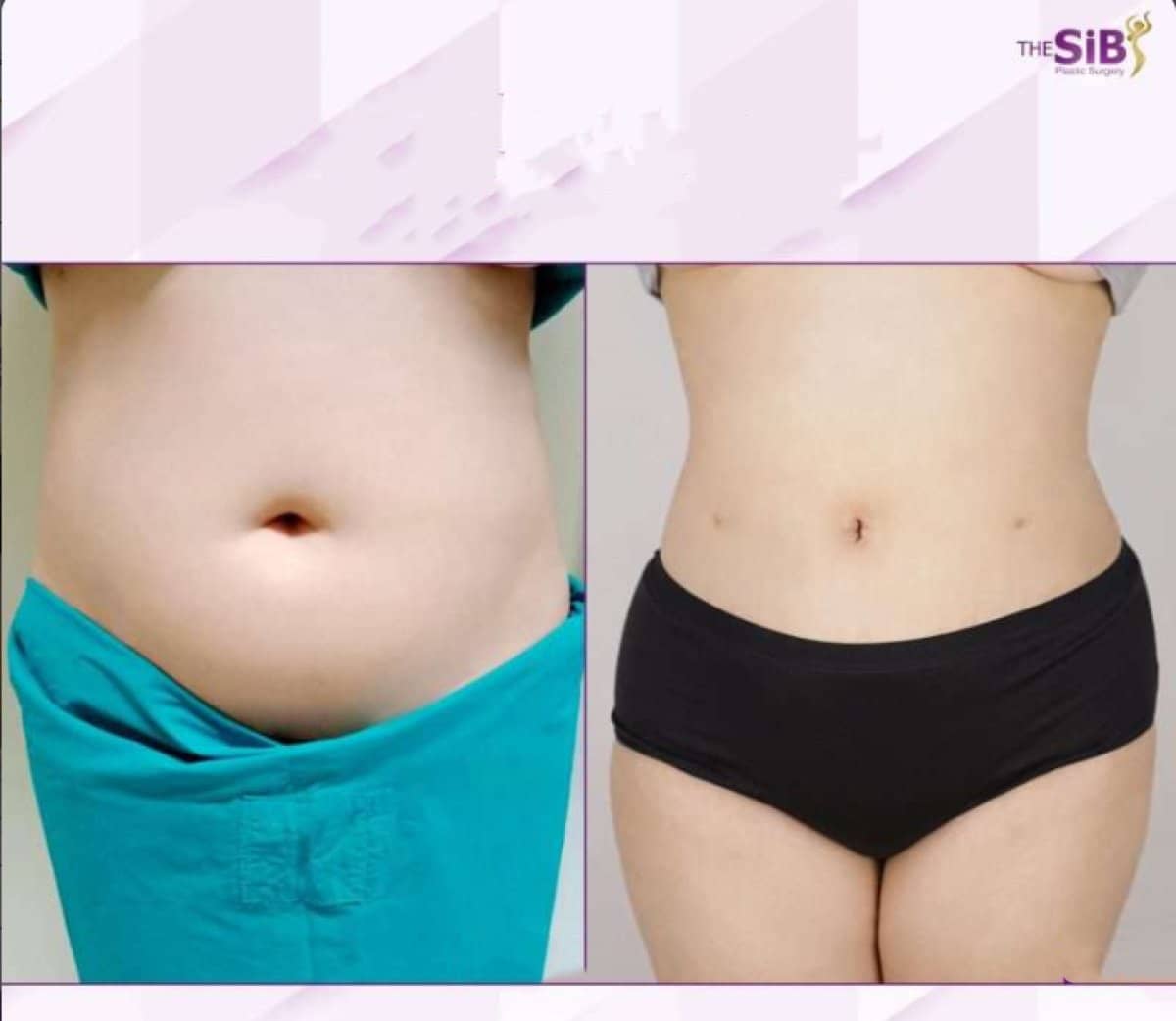 Case 14648 - liposuction